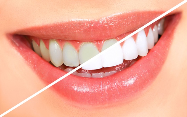 Tẩy trắng răng tại nha khoa Cần Thơ có bị ê buốt không