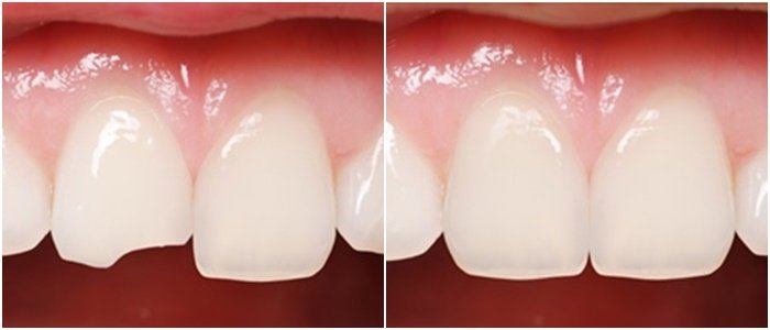 Những điểm cần lưu ý khi trám răng cửa | Trám răng Cần Thơ