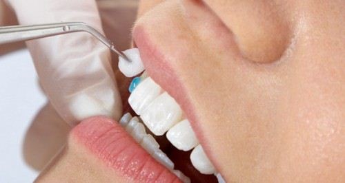 Răng sứ có sử dụng được vĩnh viễn - Răng sứ Cần Thơ